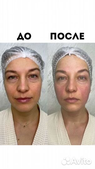 Массаж, ручная липопластика