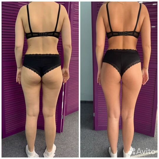 Массаж Vela Shape, круче чем LPG