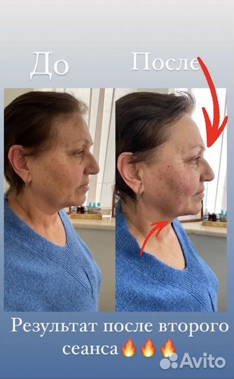 Массаж/ коррекция фигуры/снижение веса/LPG