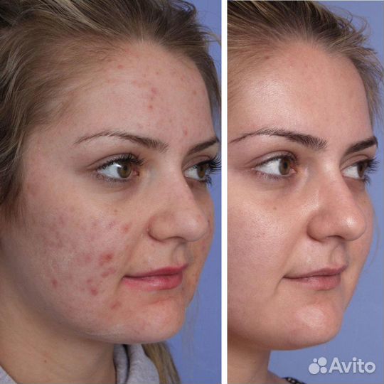 Забудьте про прыщи. Акне, постакне, лечение