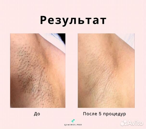 Диодный лазер Lumines Max’One 1200