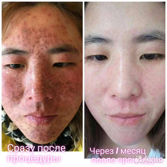 Фотоомолож-е,удаление пигментации,веснушек,купероз