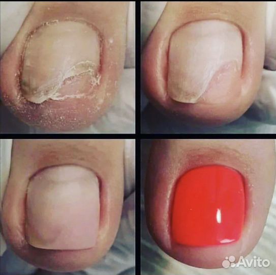 Лечебный педикюр Подолог