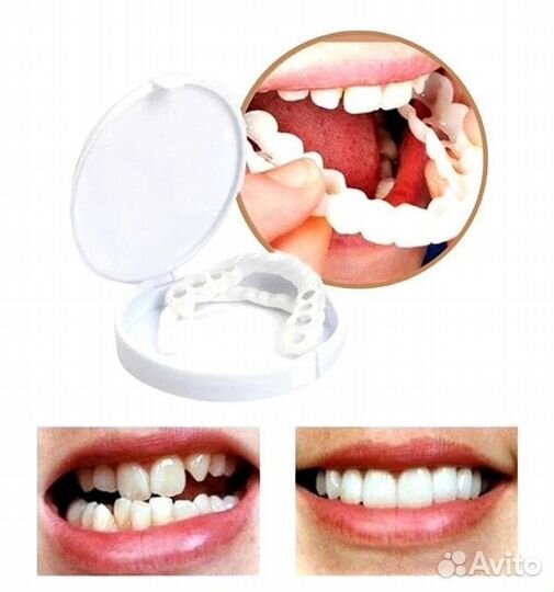 Виниры комплект на обе челюсти