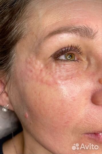 Биоревитализация. Мезотерапия