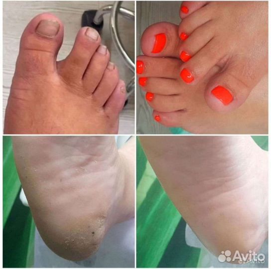 Педикюр мужской, женский,подолог,нить