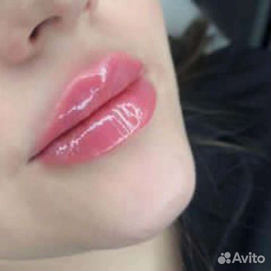 Контурная пластика