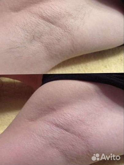 Депиляция воском: глубокое бикини