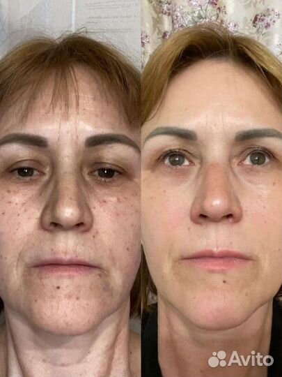 Плазмофиллинг, Плазмотерапия, Мезо, Чистка, Пилинг