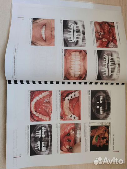 Регенеративные методы в имплантологии