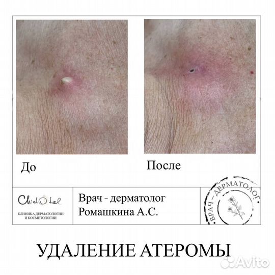 Удаление папиллом, родинок, бородавок