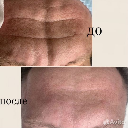 Увеличение губ