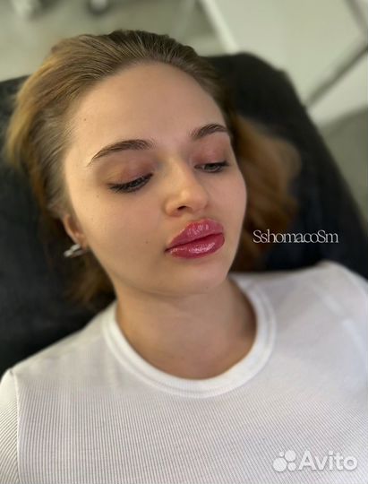 Увеличение губ