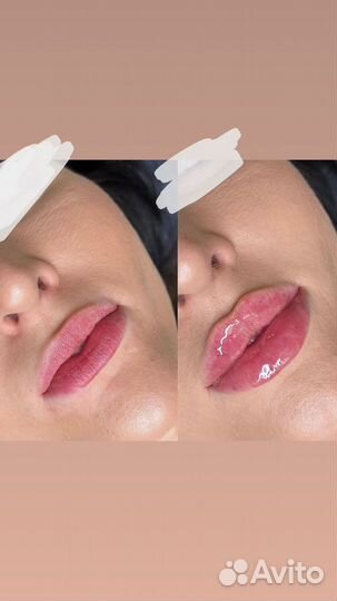 Требуются модели на всю контурную пластику