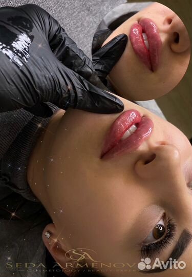 Косметолог. Увеличение губ. Ботокс