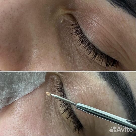 Милиум/Белые угри/Чистка