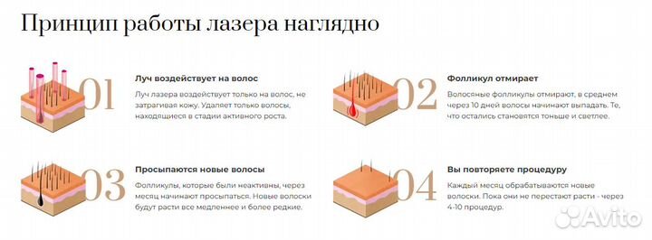 Лазерная эпиляция в Питере