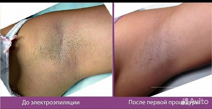 Электроэпиляция