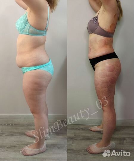 Аппаратная коррекция фигуры