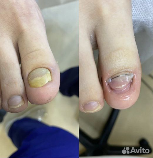 Подолог (сложные ногти и стопы)