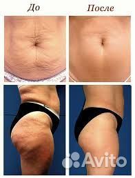 Лазерная эпиляция, вакуумный массаж, кавитация