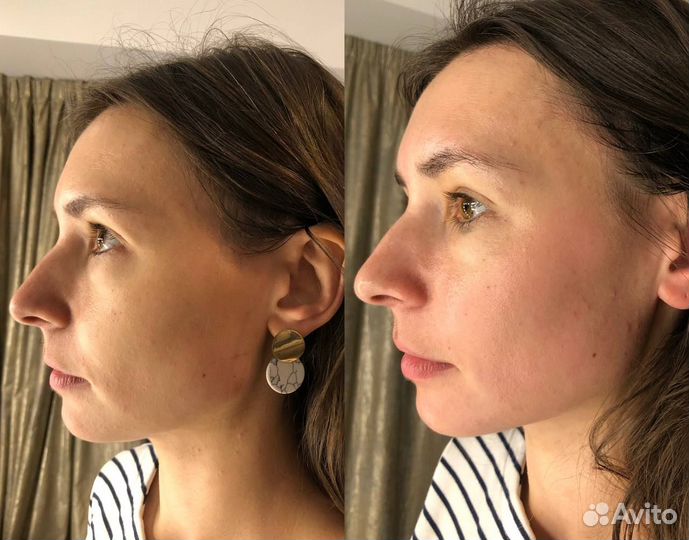 Сплит массаж лица/буккальный массаж косметолог