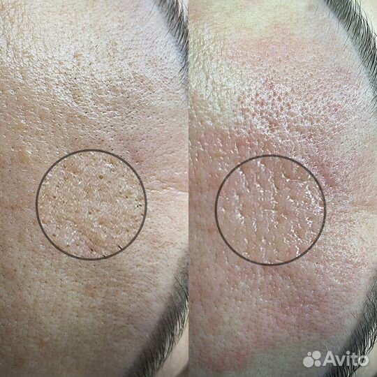 Чистка лица