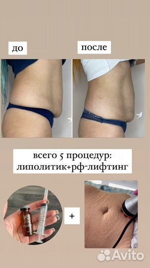 LPG массаж, микроигольчатый RF-лифтинг, кавитация