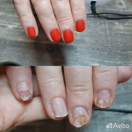 Подолог. Работа со сложными стопами и ногтями