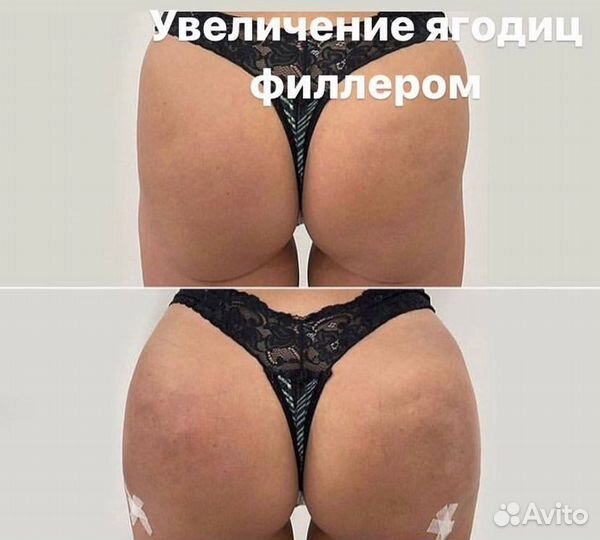 Увеличение ягодиц