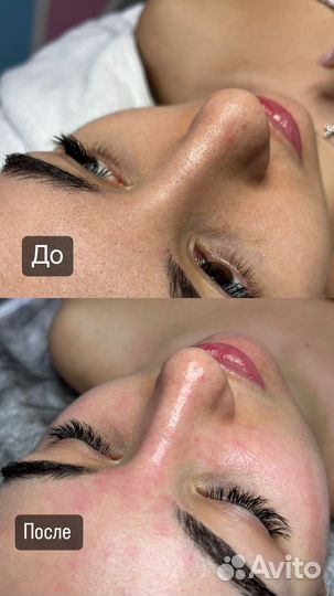 Косметолог, чистка, пилинг, массаж лица
