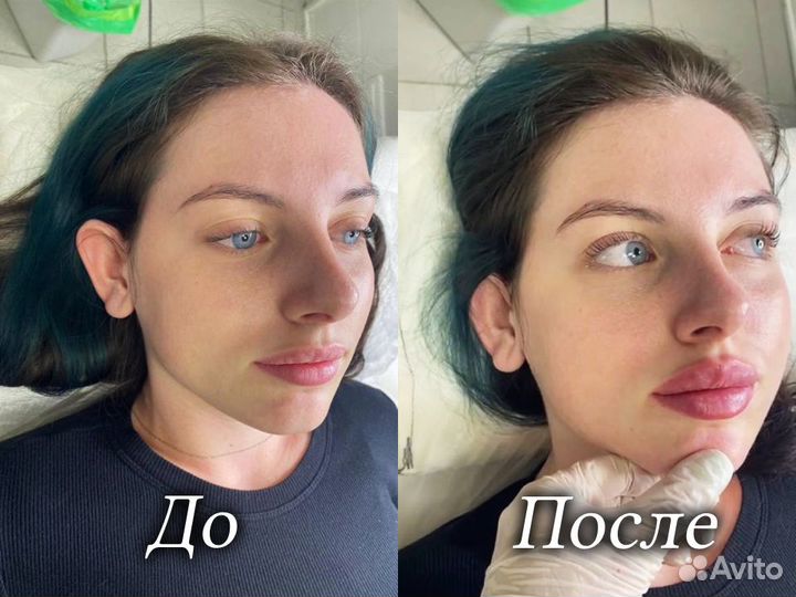 Косметолог. Увеличение губ
