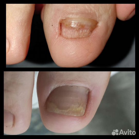 Подолог, вросший ноготь, сложный педикюр