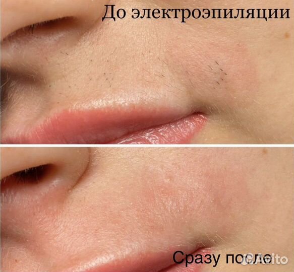 Электроэпиляция