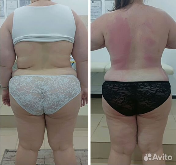 Массаж. Аппаратная коррекция фигуры. Снижение веса