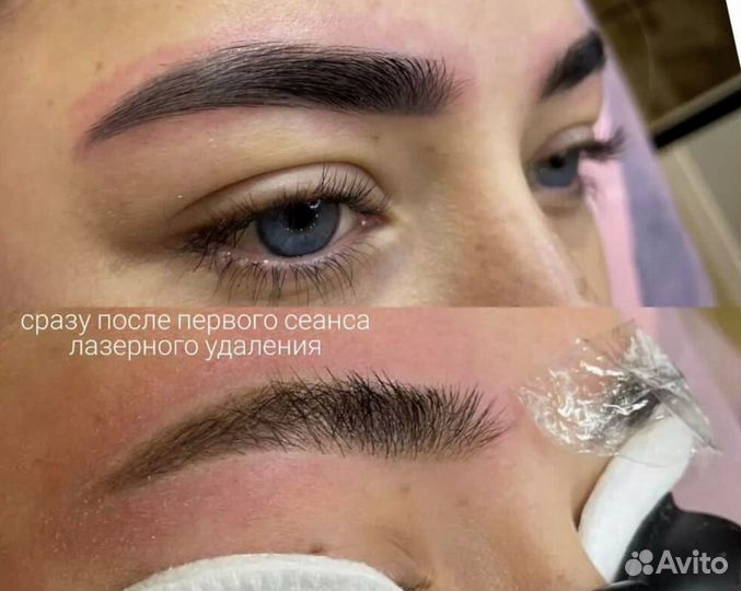 Удаление татуировок лазером