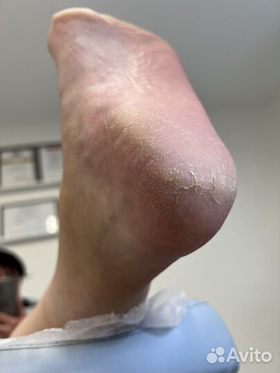 Лечебный педикюр подолог Препаратный педикюр