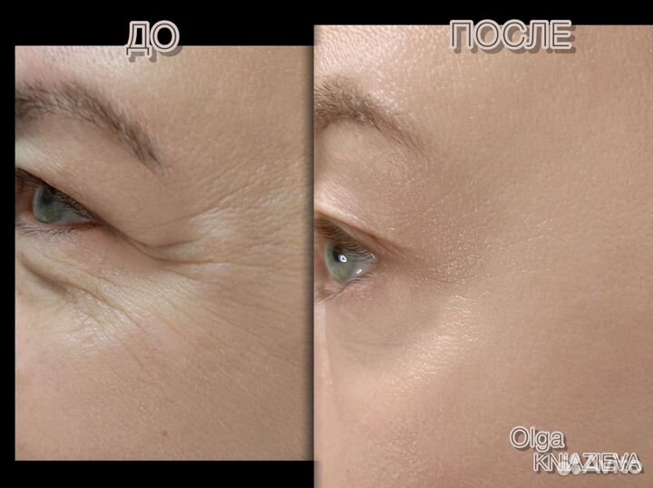 Нужны модели на процедуру Botox