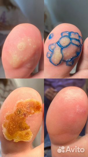 Педикюр подолог