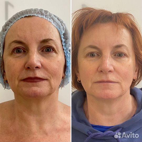 СМАС лифтинг