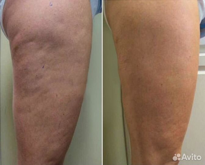 Аппаратный массаж,RF лифтинг, липолиз, кавитация