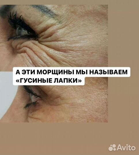 Релатокс, Ботокс