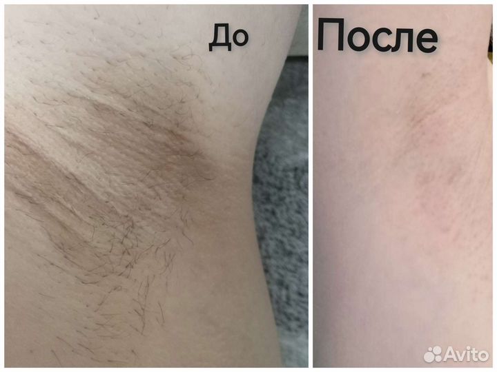 Восковая депиляция