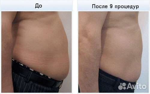 LPG массаж на Воронежской