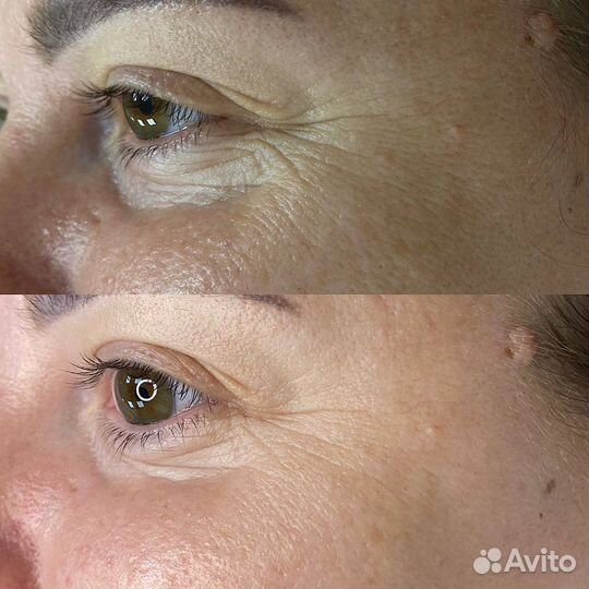 Омоложение лица FlaxSculpt