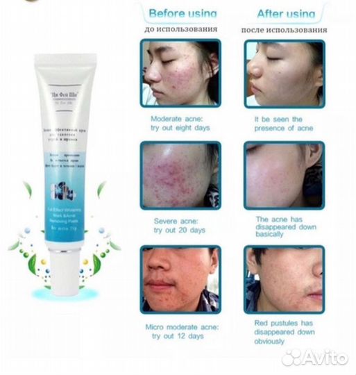 Крем от прыщей