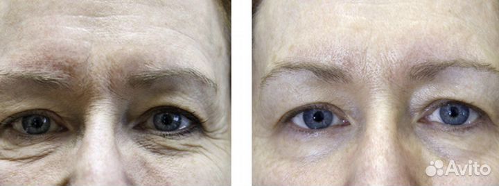 Exilis ultra 360