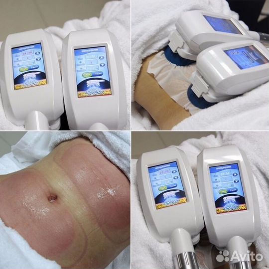 3D Криолиполиз в клинике м.Уралмаш