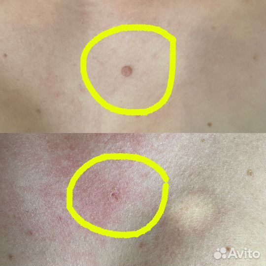 Удаление папиллом, гемангиом, родинок, сосудов