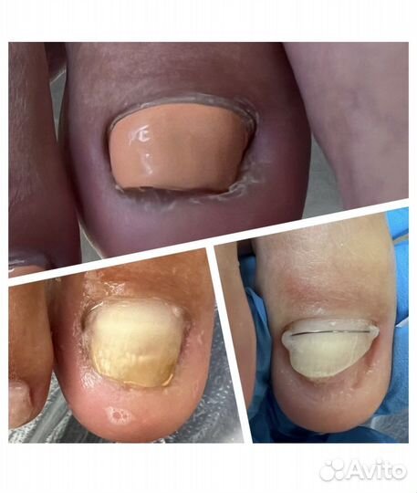 Педикюр сложных стоп